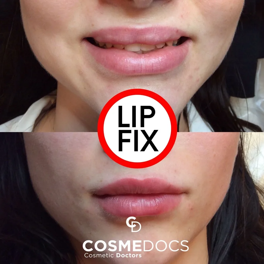 Lip filler correction — over-filled lips dissolved and re-shaped