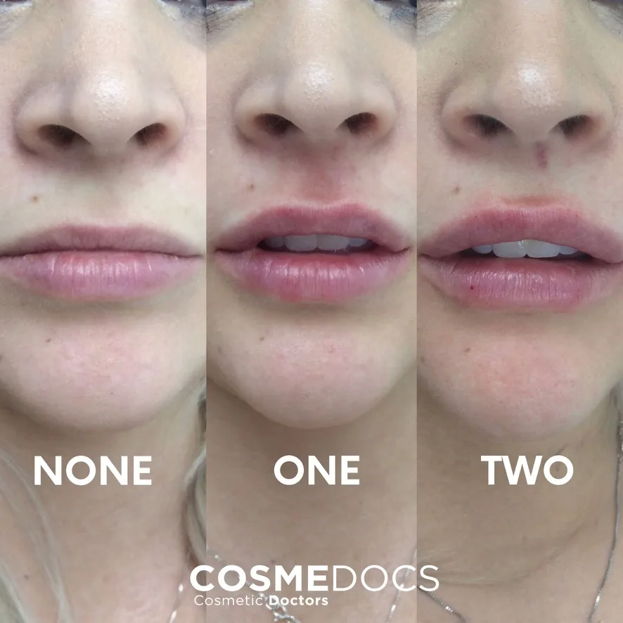 Lip filler progression showing results after one and two treatment sessions