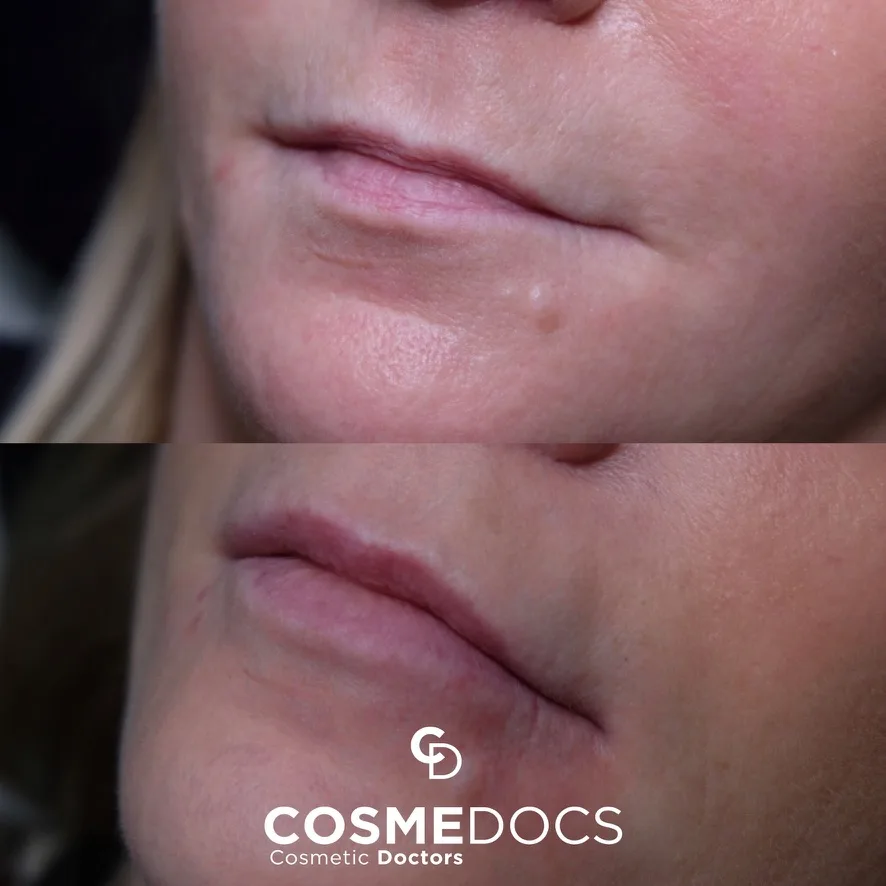 Lip filler side profile before and after — natural lip shape