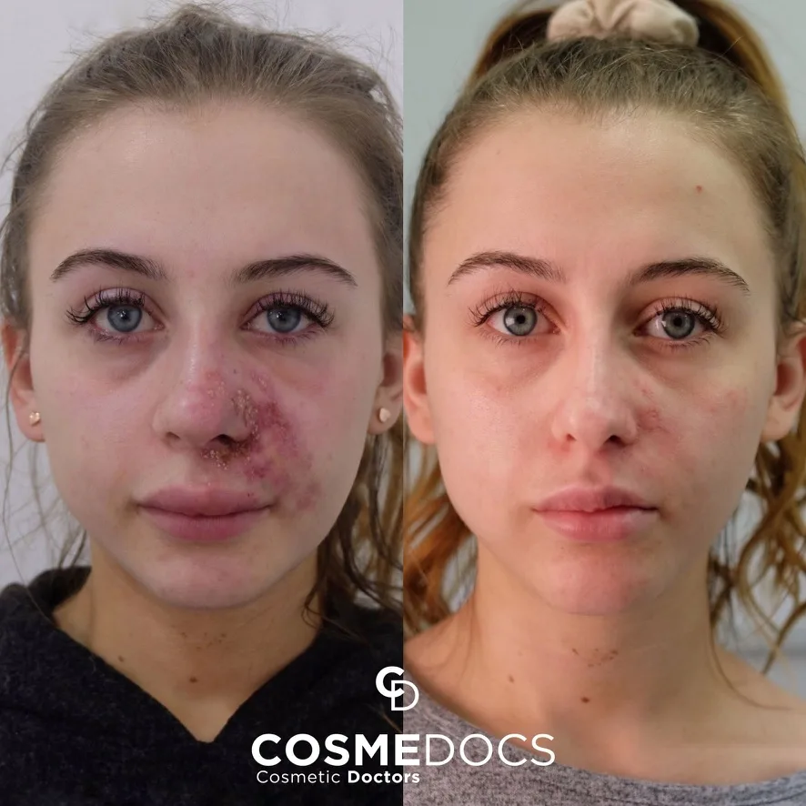 Vascular occlusion complication management before and after showing complete recovery