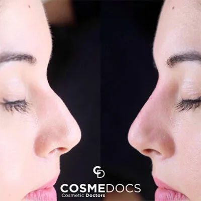 Profile harmony improvement before and after nose filler treatment