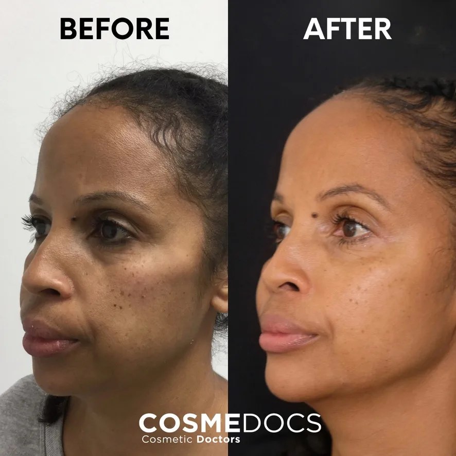 Before and after full face makeover profile view showing natural facial balance with multi-point dermal filler