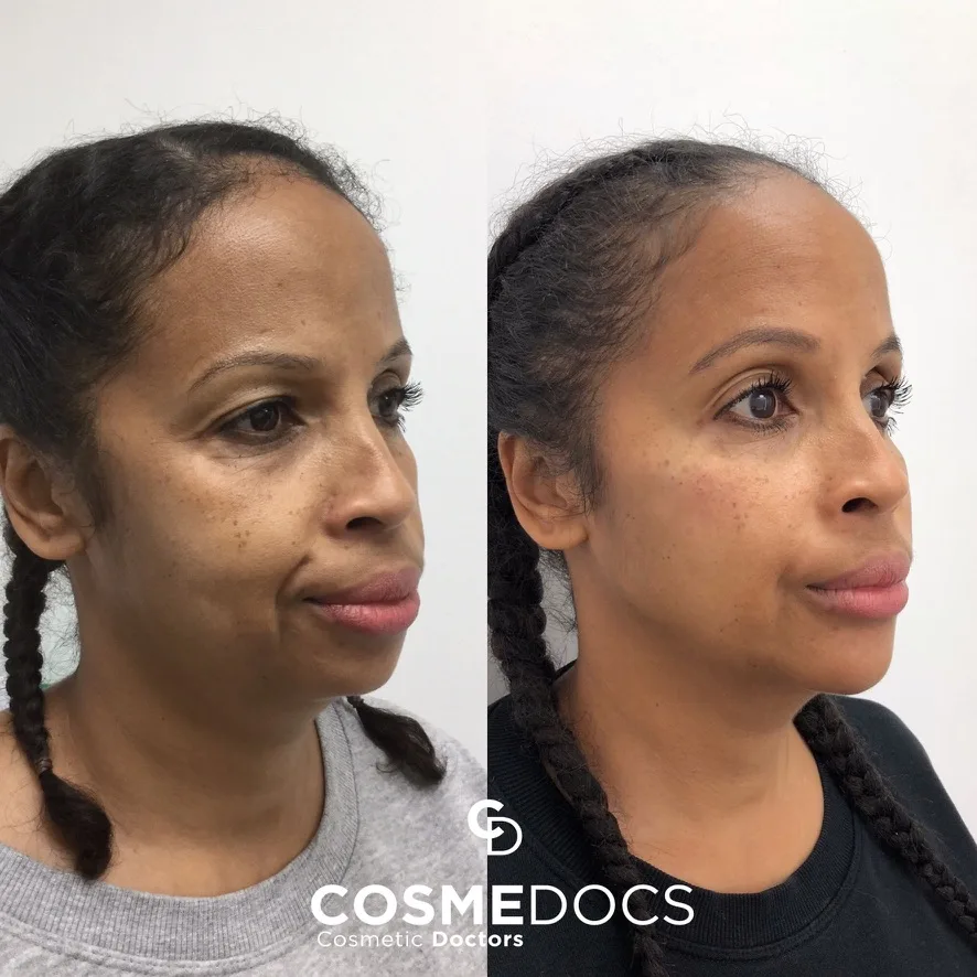 Before and after full face makeover showing natural facial balance and harmonious results
