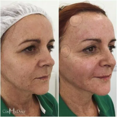 PDO thread lift before and after image performed in London showing improved jawline definition