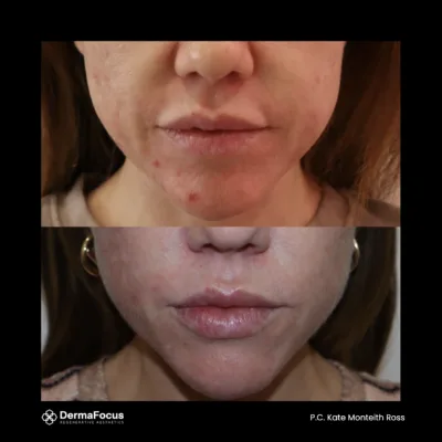 Before and after images showing the rejuvenating effects of polynucleotides on skin, highlighting smoother texture and reduced fine lines.
