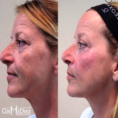 PDO thread lift before and after procedure showing facial lifting and contouring results