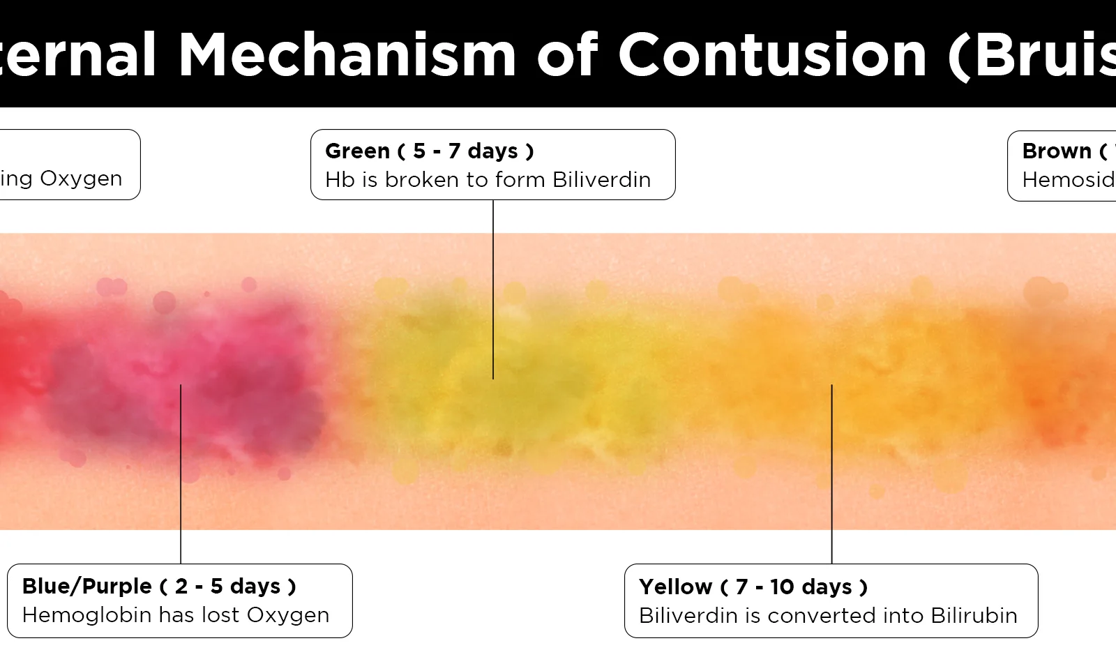 Bruise healing colour spectrum showing progression from red to yellow