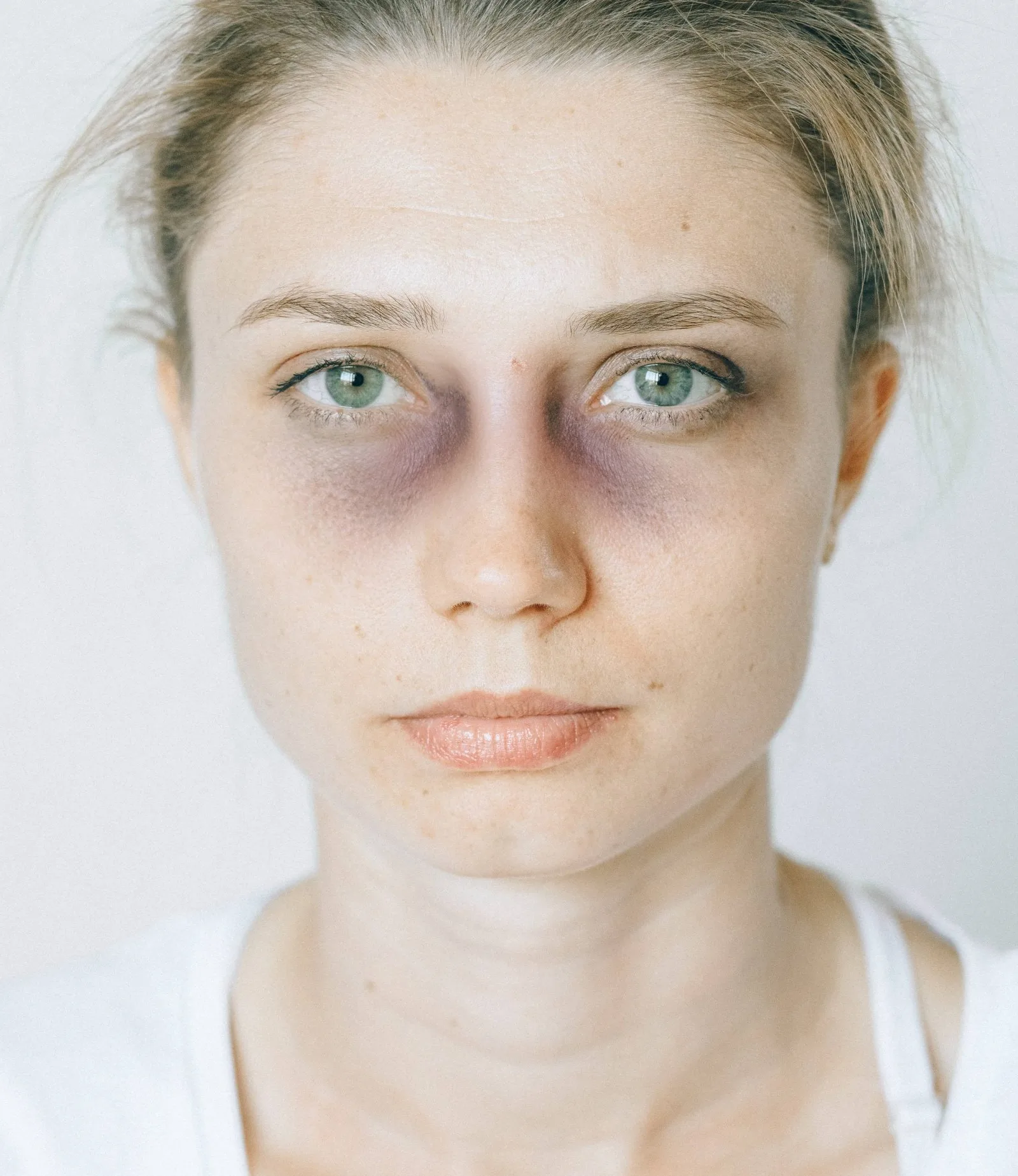 Medical guide to treating and healing bruises quickly