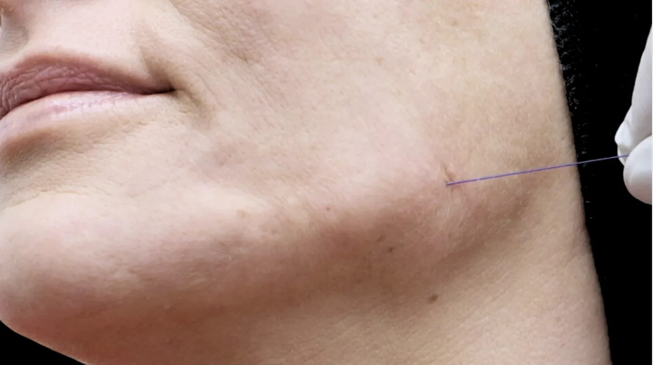 Close-up of a PDO cog thread being inserted beneath the skin — showing the fine barbed suture used for tissue lifting