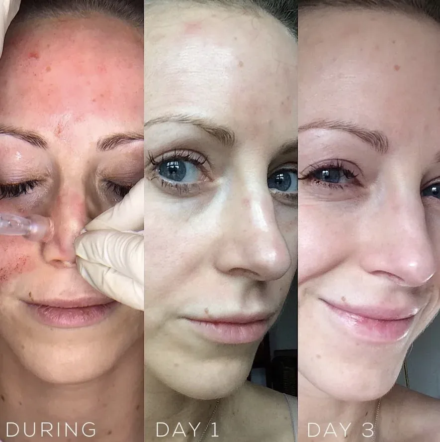 Skin rejuvenation before and after showing improved texture and radiance