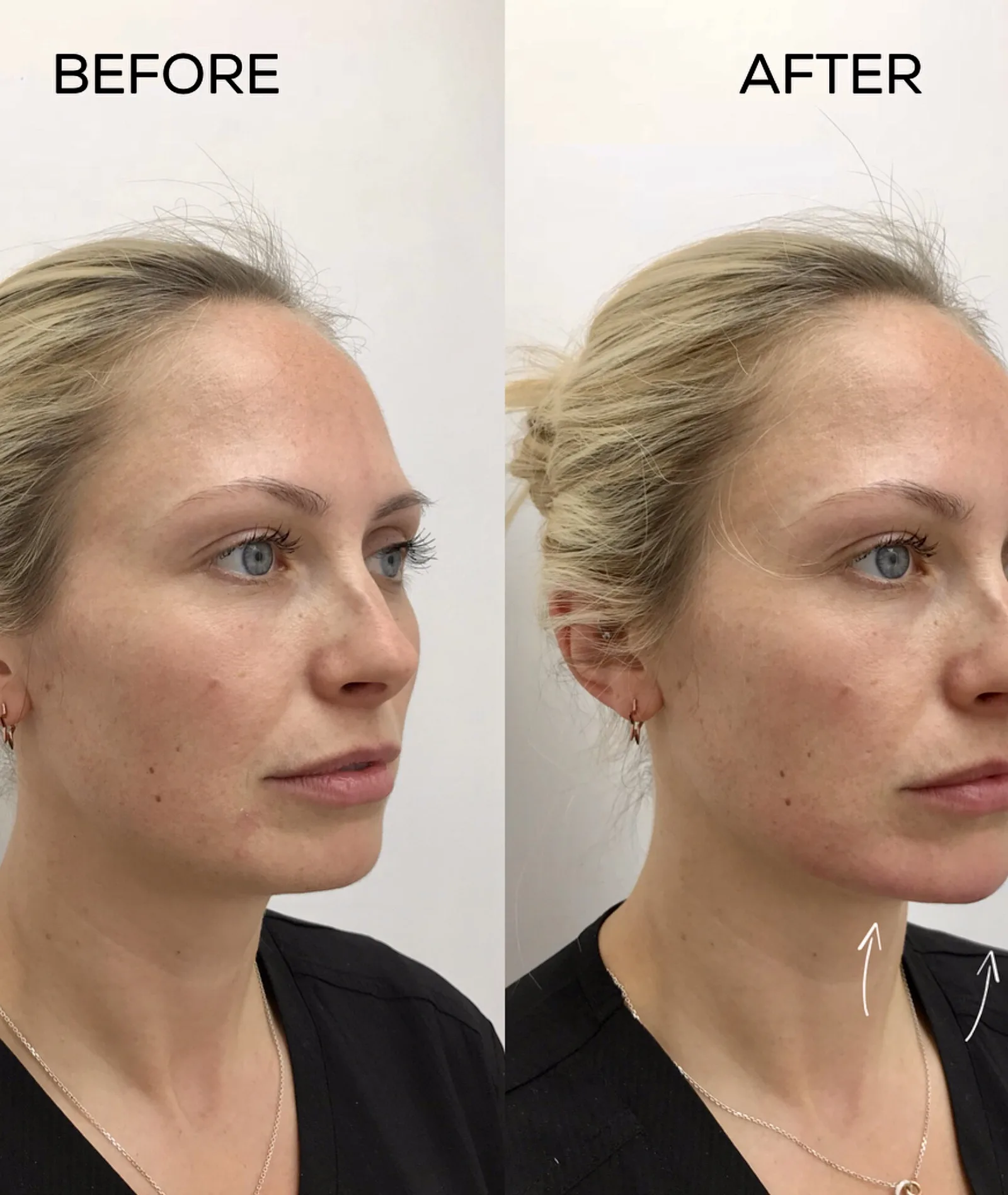 Botox Results