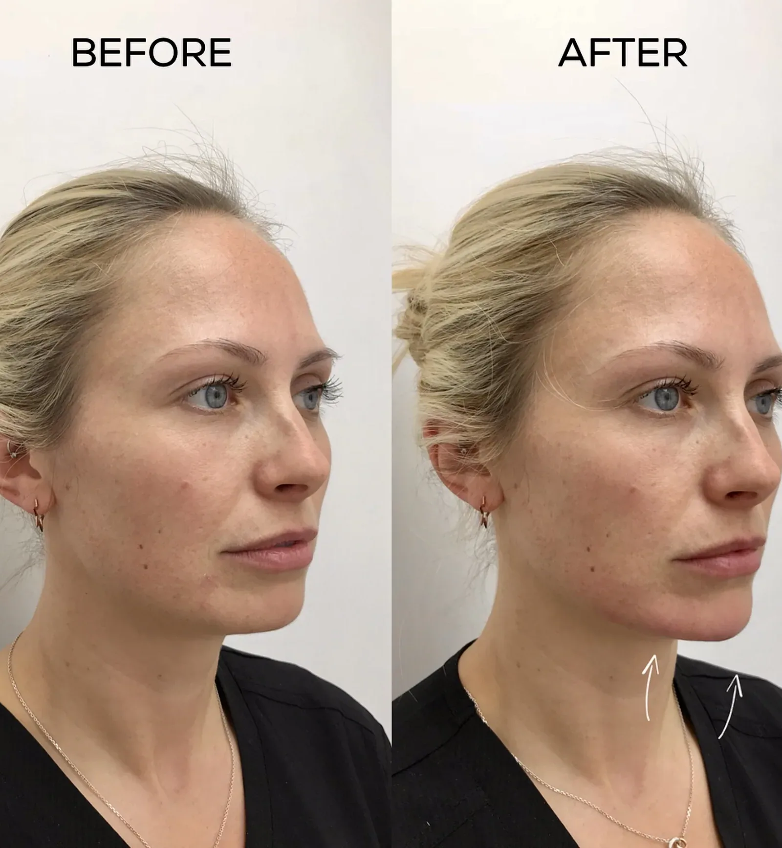 Botox Results