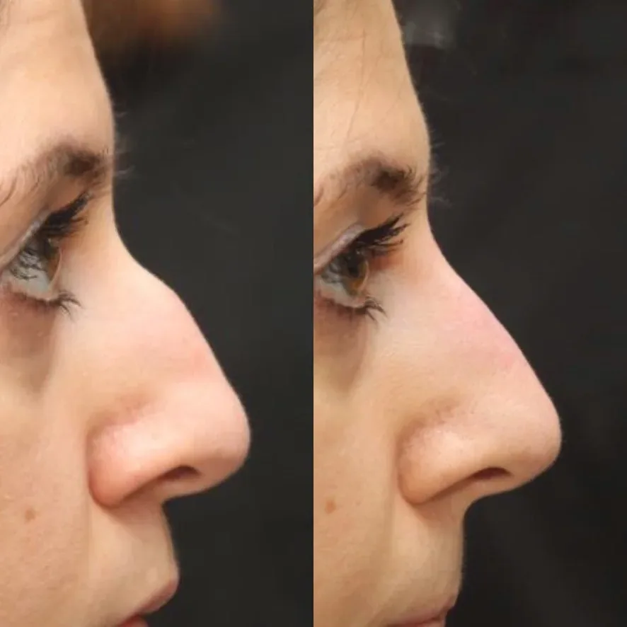 Nose reshaping profile dermal filler London Cosmedocs Dr Ahmed Haq