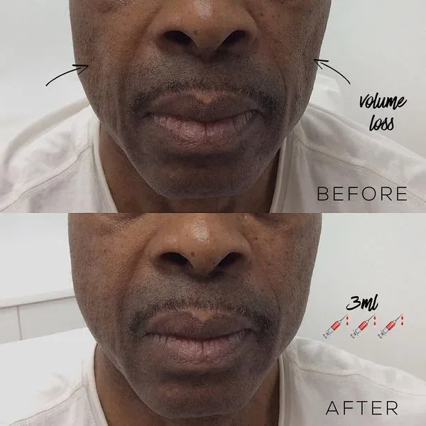 Before and after cheek volume restoration addressing hollow cheeks