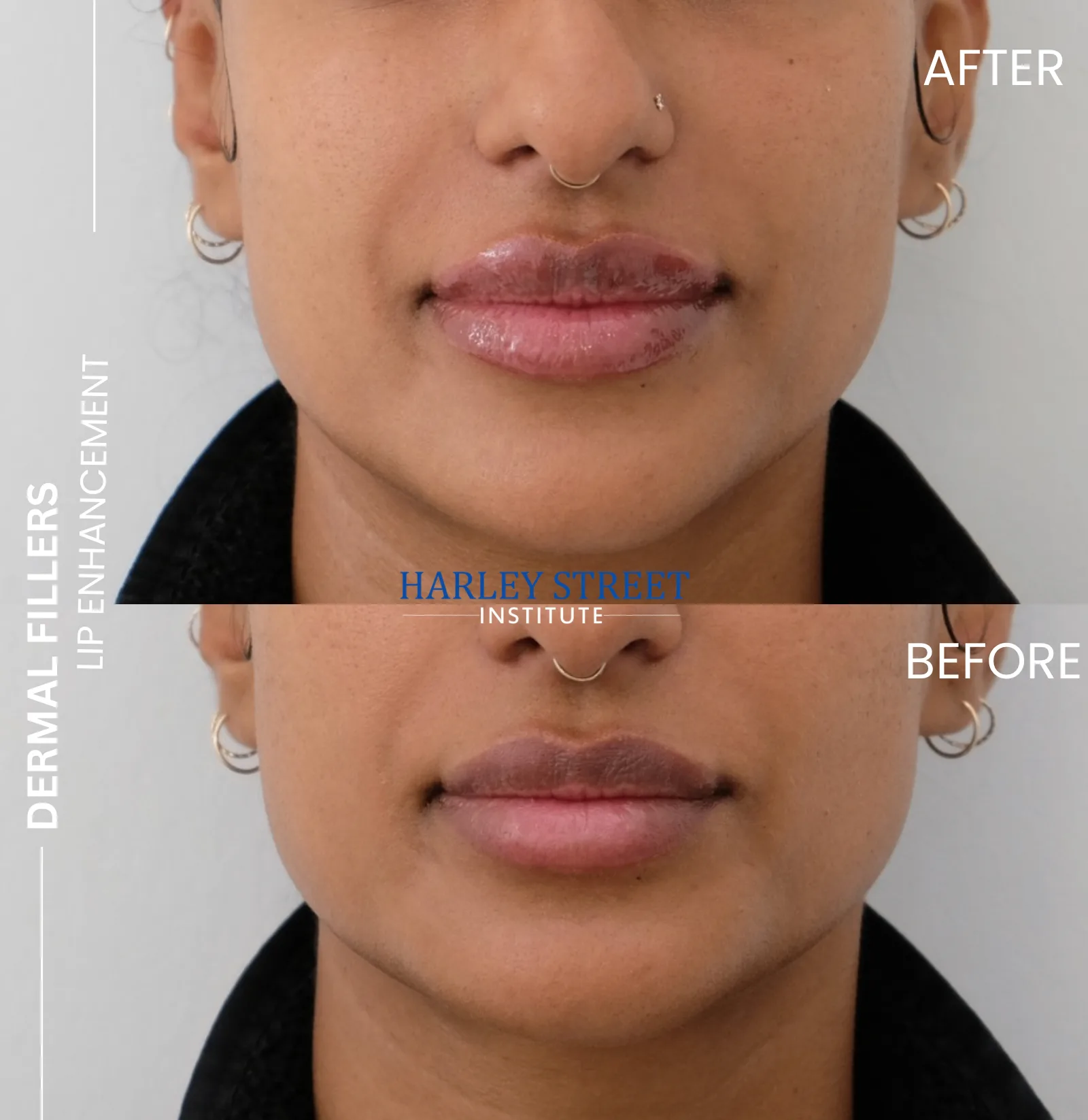 Natural lip enhancement before and after results