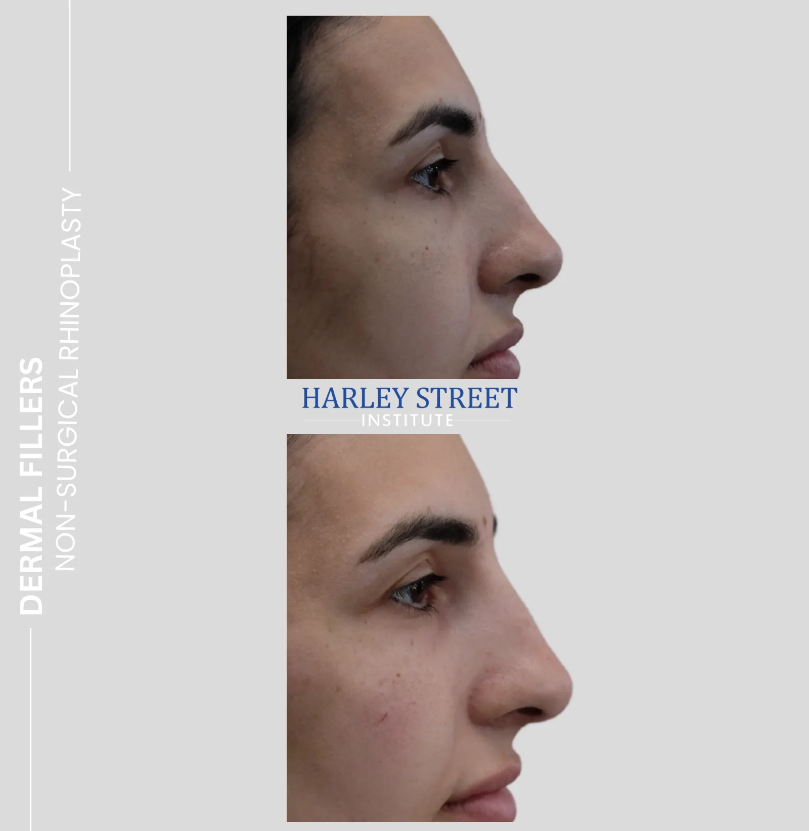 Non-surgical rhinoplasty nose reshaping results