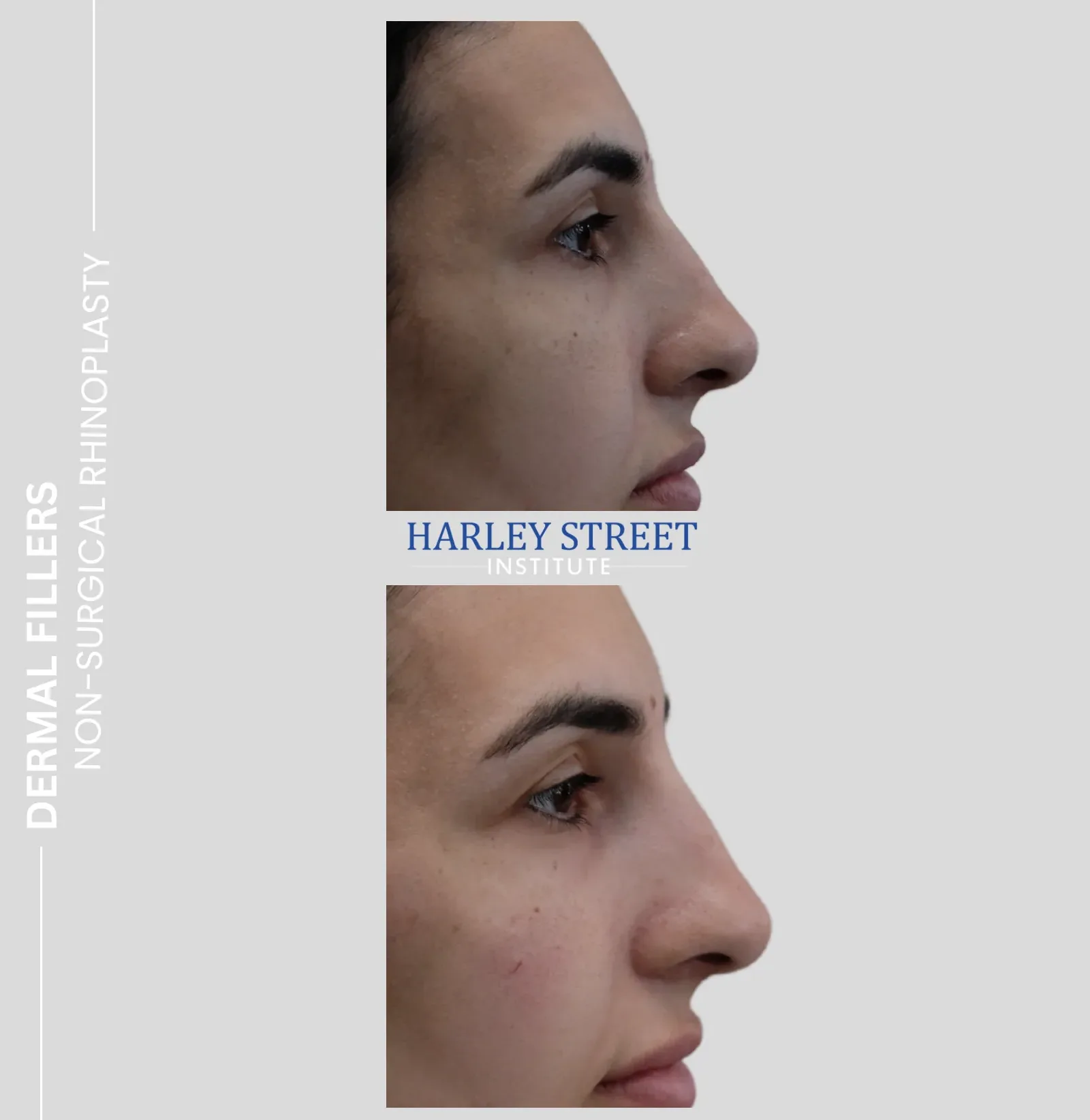 Non-surgical rhinoplasty nose reshaping results