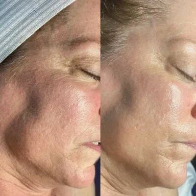 HydraFacial before and after skin texture improvement