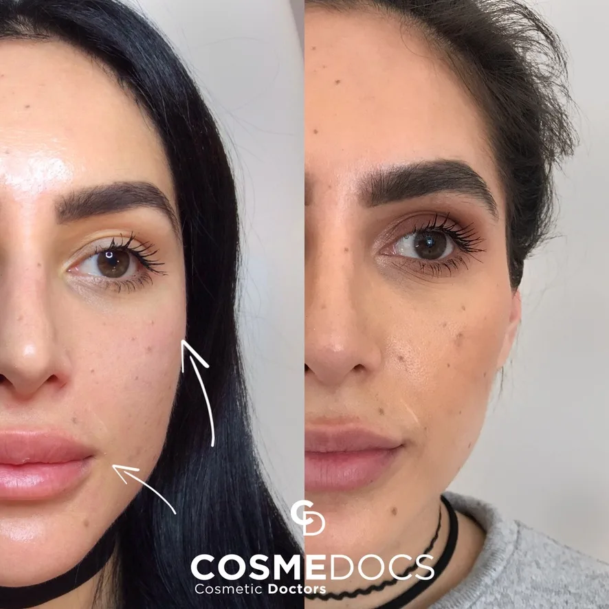 Before and after cheek filler showing natural feminine enhancement