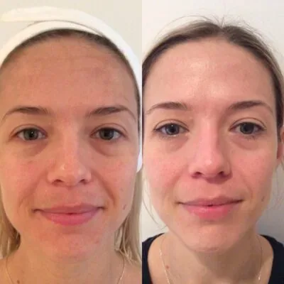 HydraFacial complexion enhancement before and after