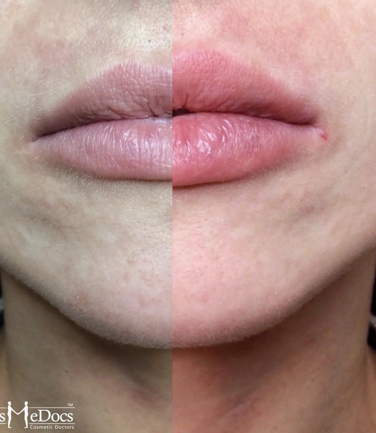 Lip enhancement before and after showing natural volume restoration in a pocketed lip shape