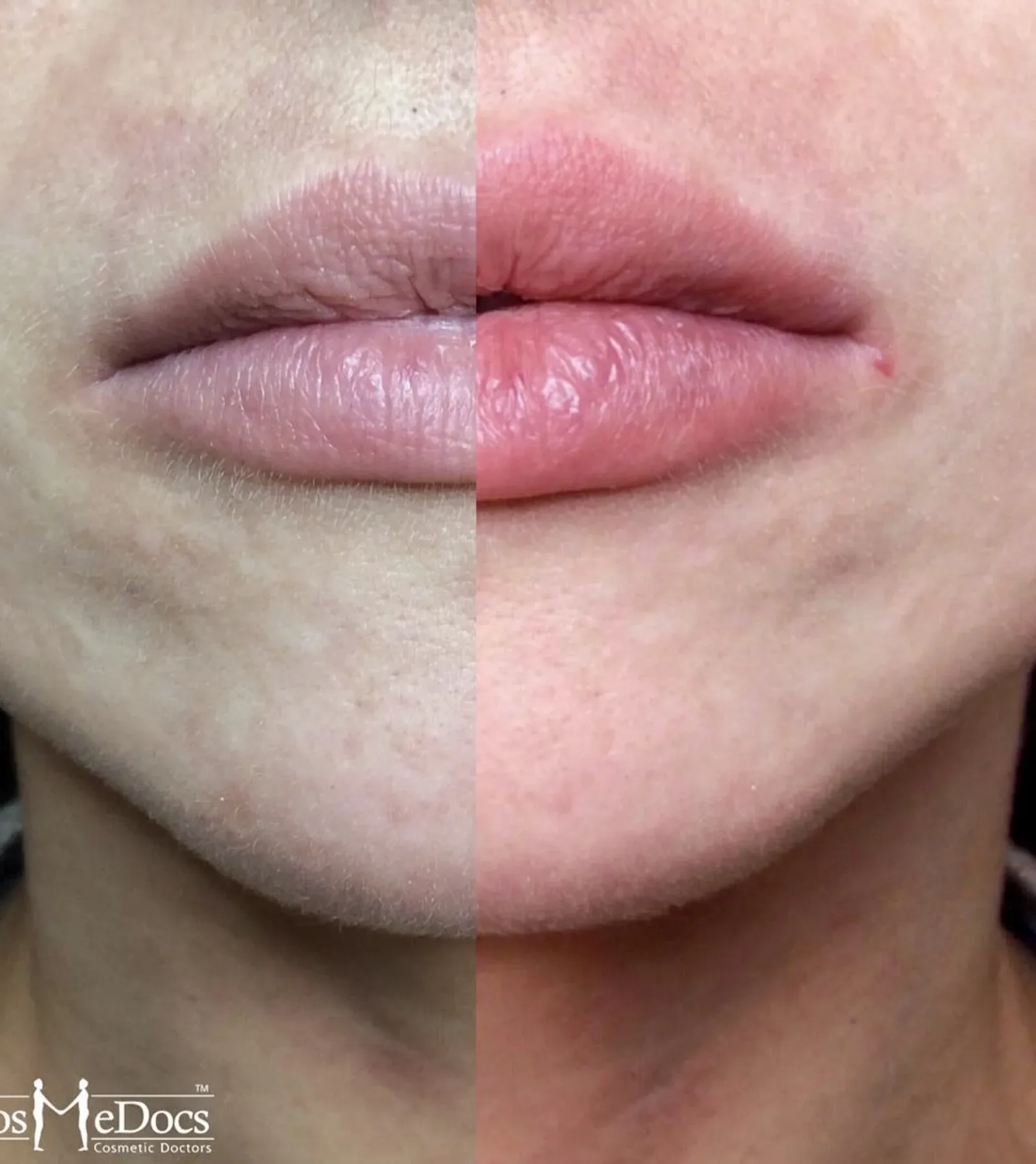 Lip enhancement before and after showing natural volume restoration in a pocketed lip shape