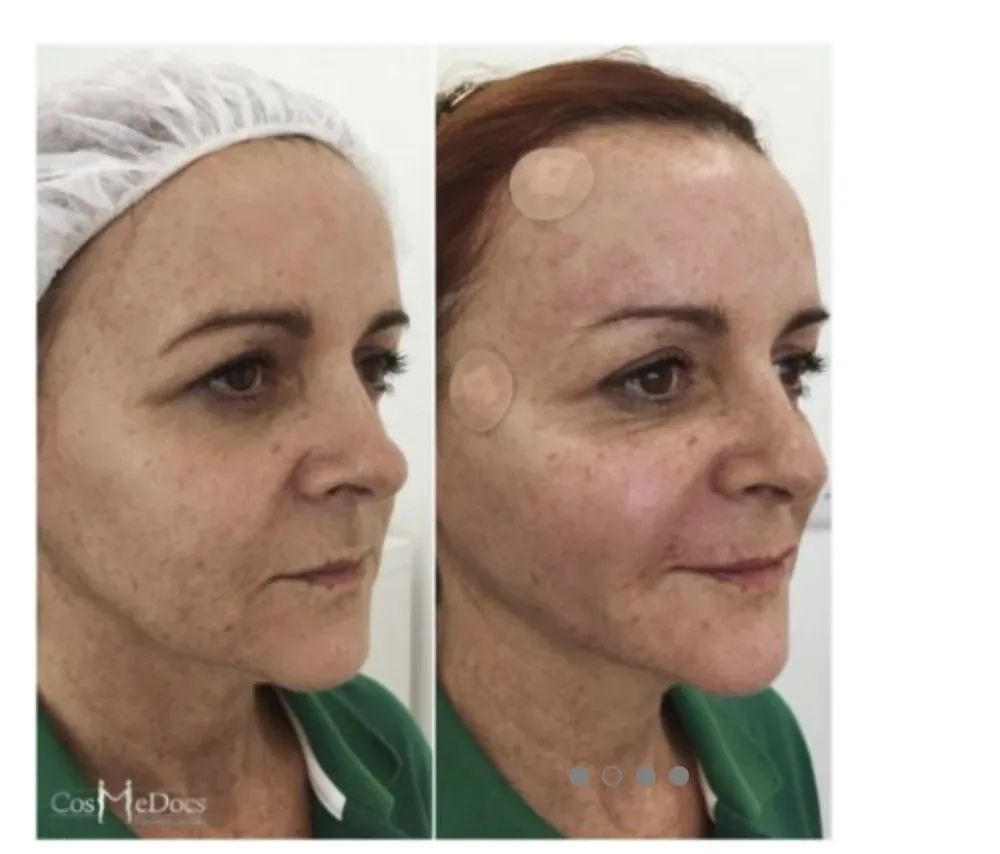 Before and after cheek enhancement showing sculpted cheekbones