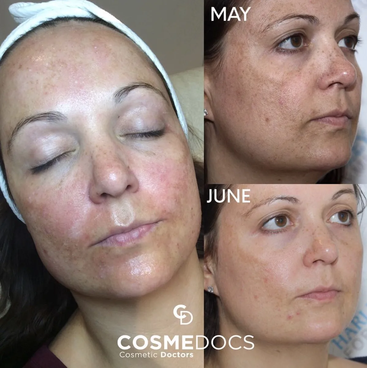 Skin Rejuvenation Results