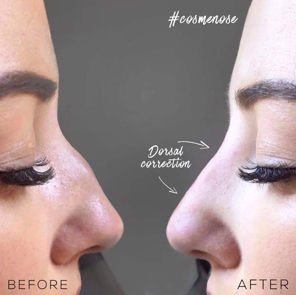 Non-surgical rhinoplasty before and after showing dorsal hump correction