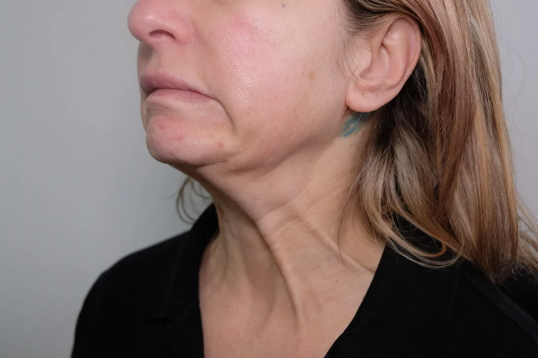 Nefertiti Lift side profile showing enhanced jawline definition after Botox to the platysma