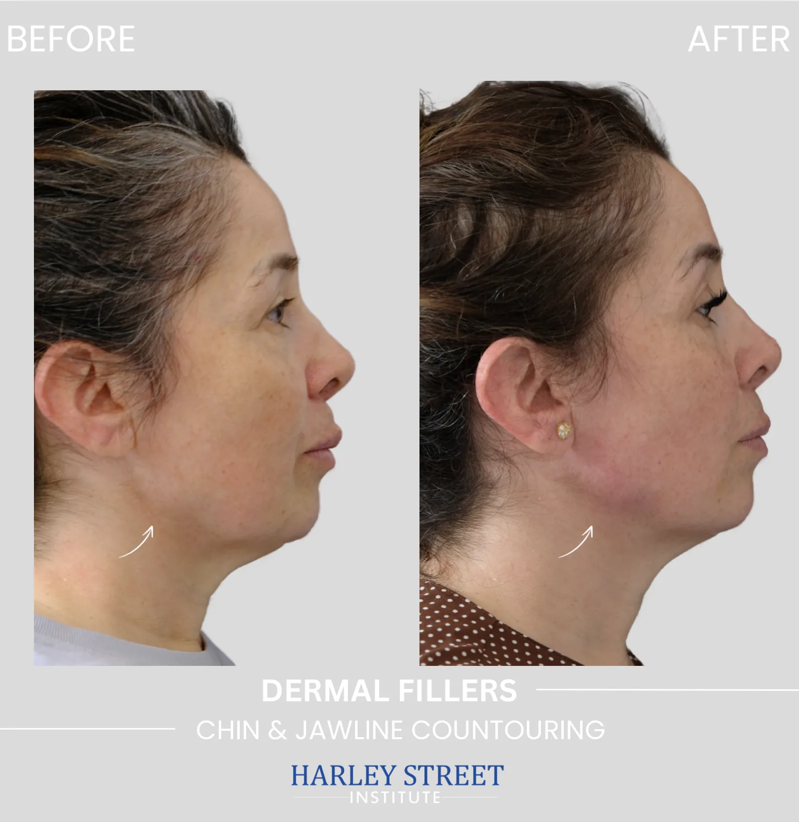Chin and jawline contouring transformation results