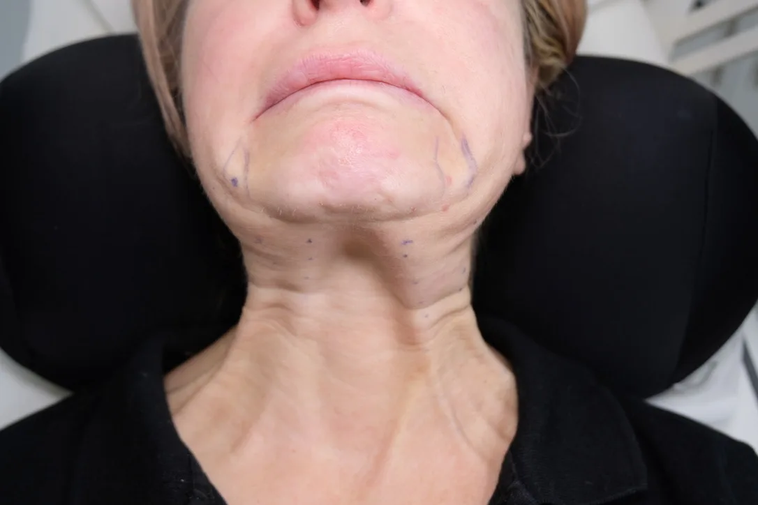 Clinical marking of prominent platysmal bands before doctor-led neck treatment