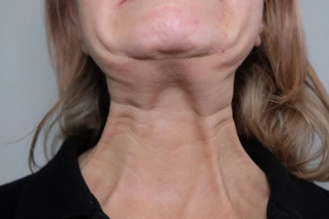 Strong vertical platysmal bands visible on the front of a patient's neck before clinical assessment