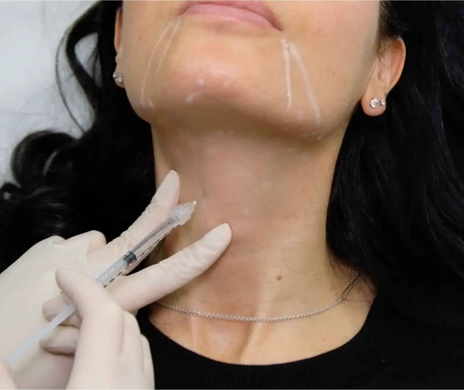 Front view of a doctor performing platysma treatment beneath the jawline