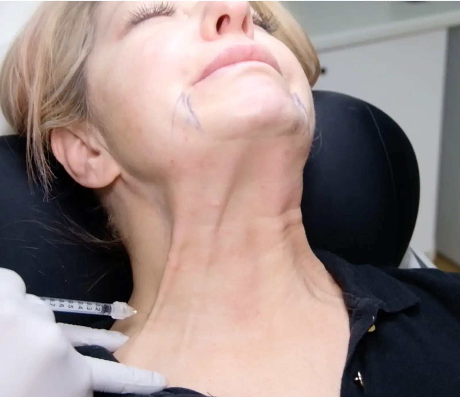 Real platysma band treatment in progress at Cosmedocs