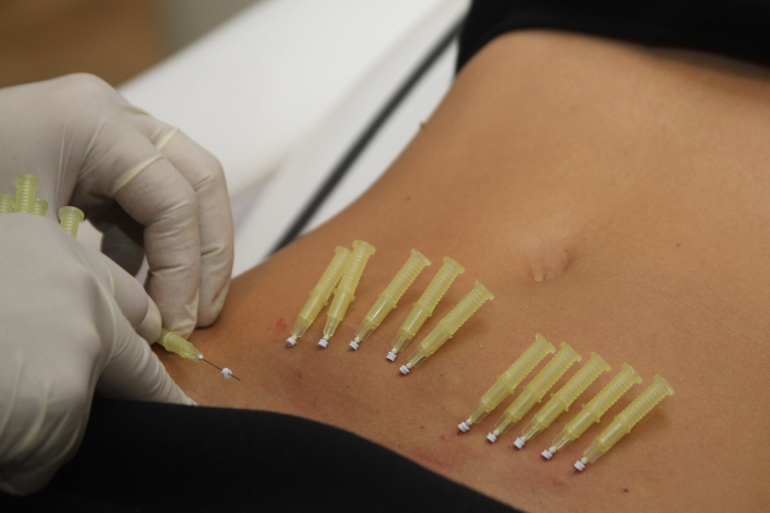 PDO mono thread insertion into the lower abdomen for skin tightening and collagen stimulation