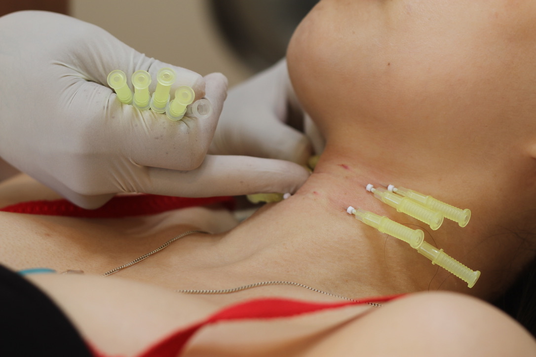 Multiple PDO mono threads inserted along the neck for skin tightening at our London clinic