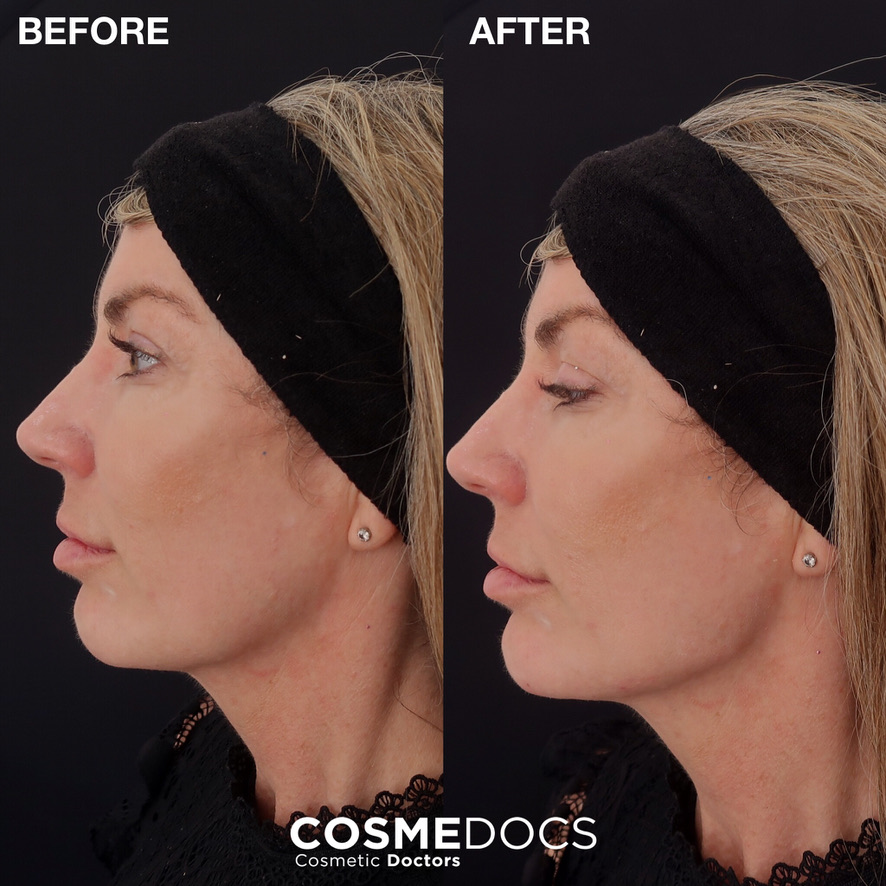 Female patient profile in her 30s — before and after 1ml of dermal filler per side at Cosmedocs, restoring the mandibular jaw angle from a softened 'I' shape back to a defined 'L' shape