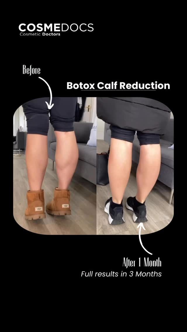 Cover frame from the Cosmedocs reel: Calf reduction at Cosmedocs