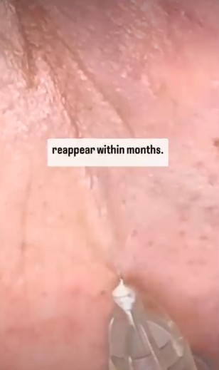 Cover frame from the Cosmedocs reel: Periorbital lines (crow's feet) filler technique