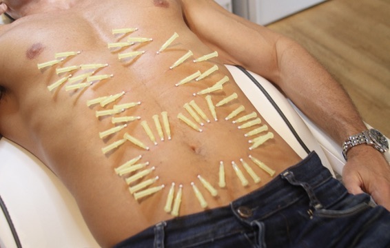 Full torso treated with a dense fan of PDO mono threads for body skin tightening