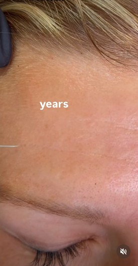 Cover frame from the Cosmedocs reel: Cannula filler for deep static lines