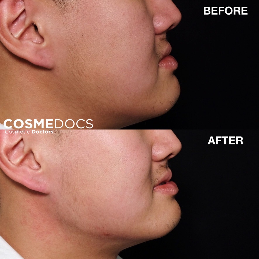 Male patient profile — before and after volume restoration at Cosmedocs, demonstrating reduction of lower-face heaviness and improved chin and jawline definition