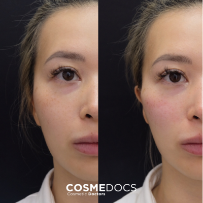 Before and after 2ml cheek filler demonstrating cheekbone definition
