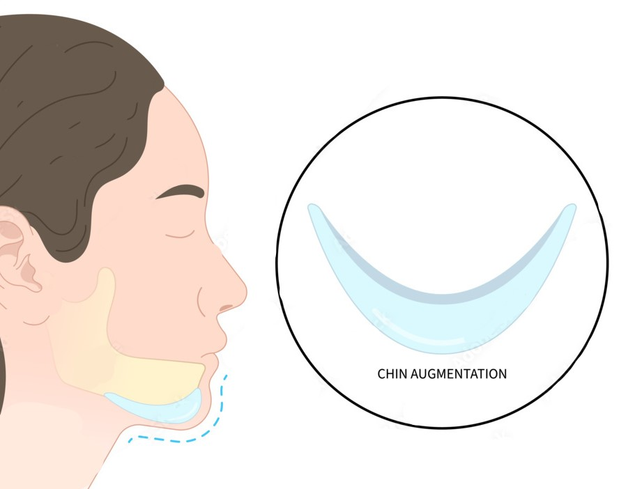 Chin augmentation diagram showing the placement and projection of chin filler in a facial profile view