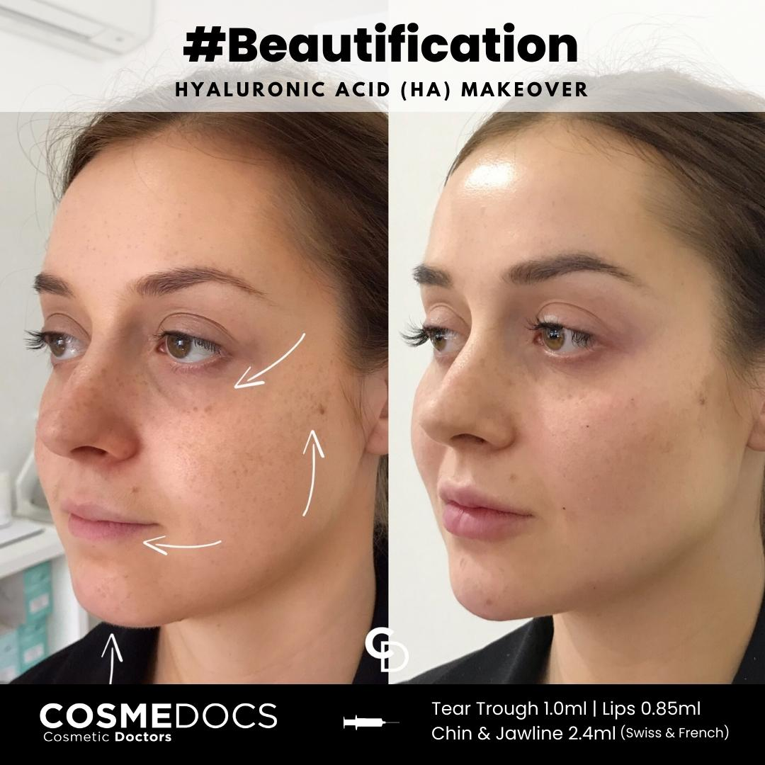 Hyaluronic acid makeover including chin, jawline, lips and tear trough showing comprehensive facial balancing