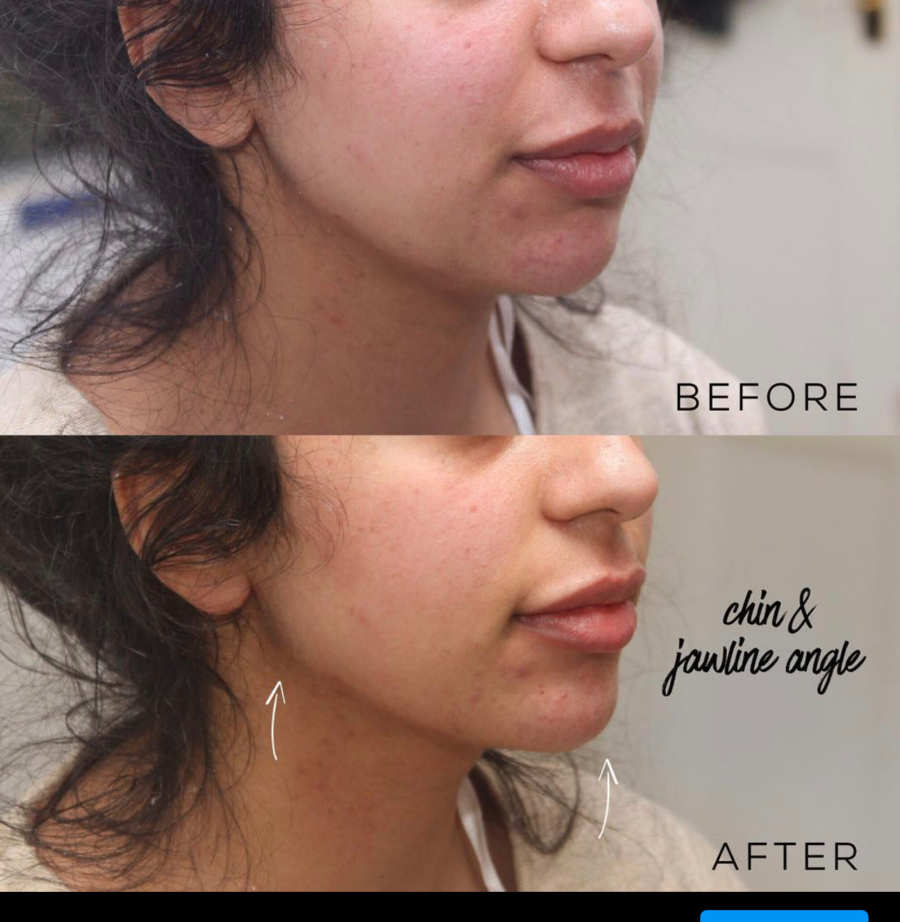 Before and after chin and jawline angle filler showing improved lower face definition and chin projection