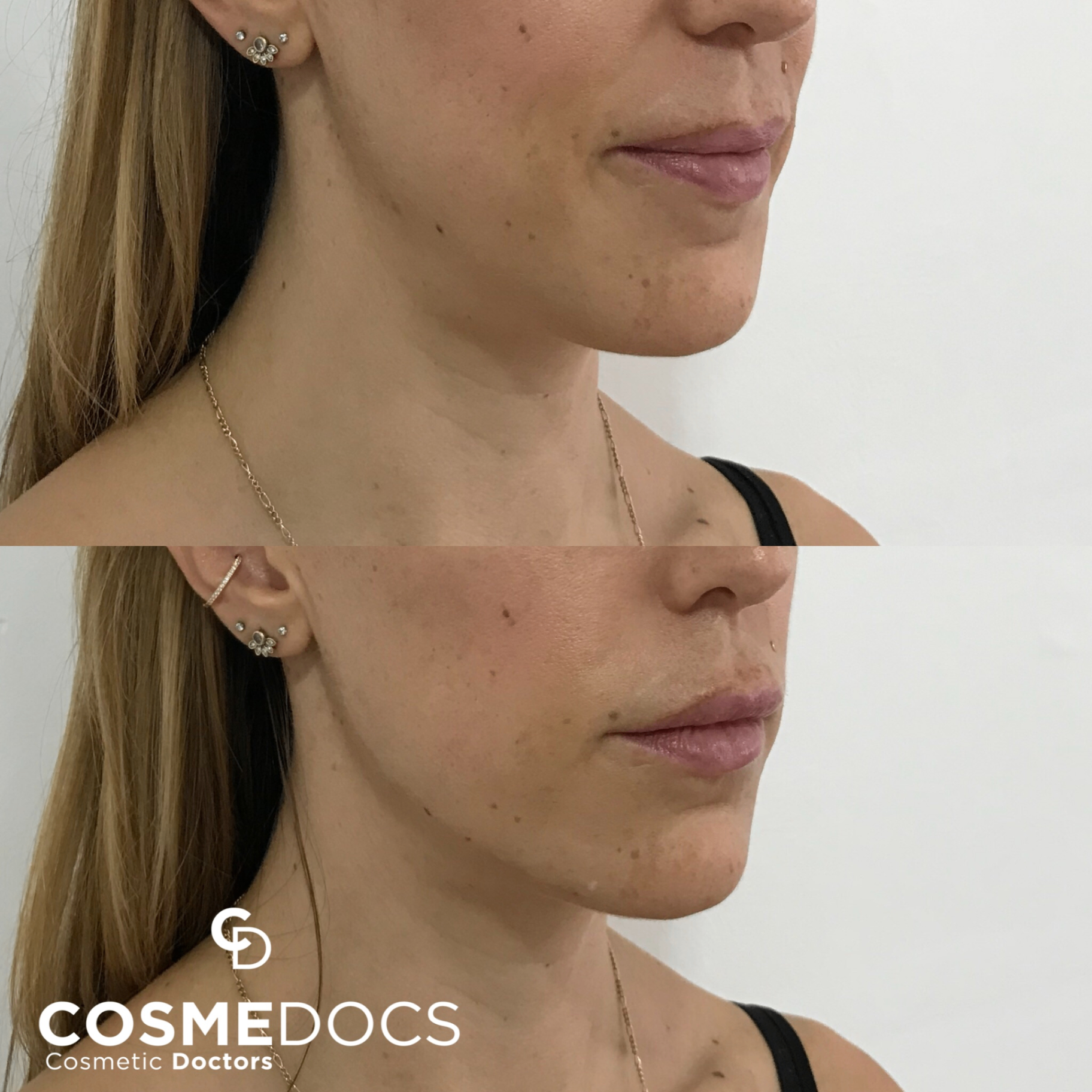 Before and after jawline filler showing subtle feminine contour improvement along the mandibular border