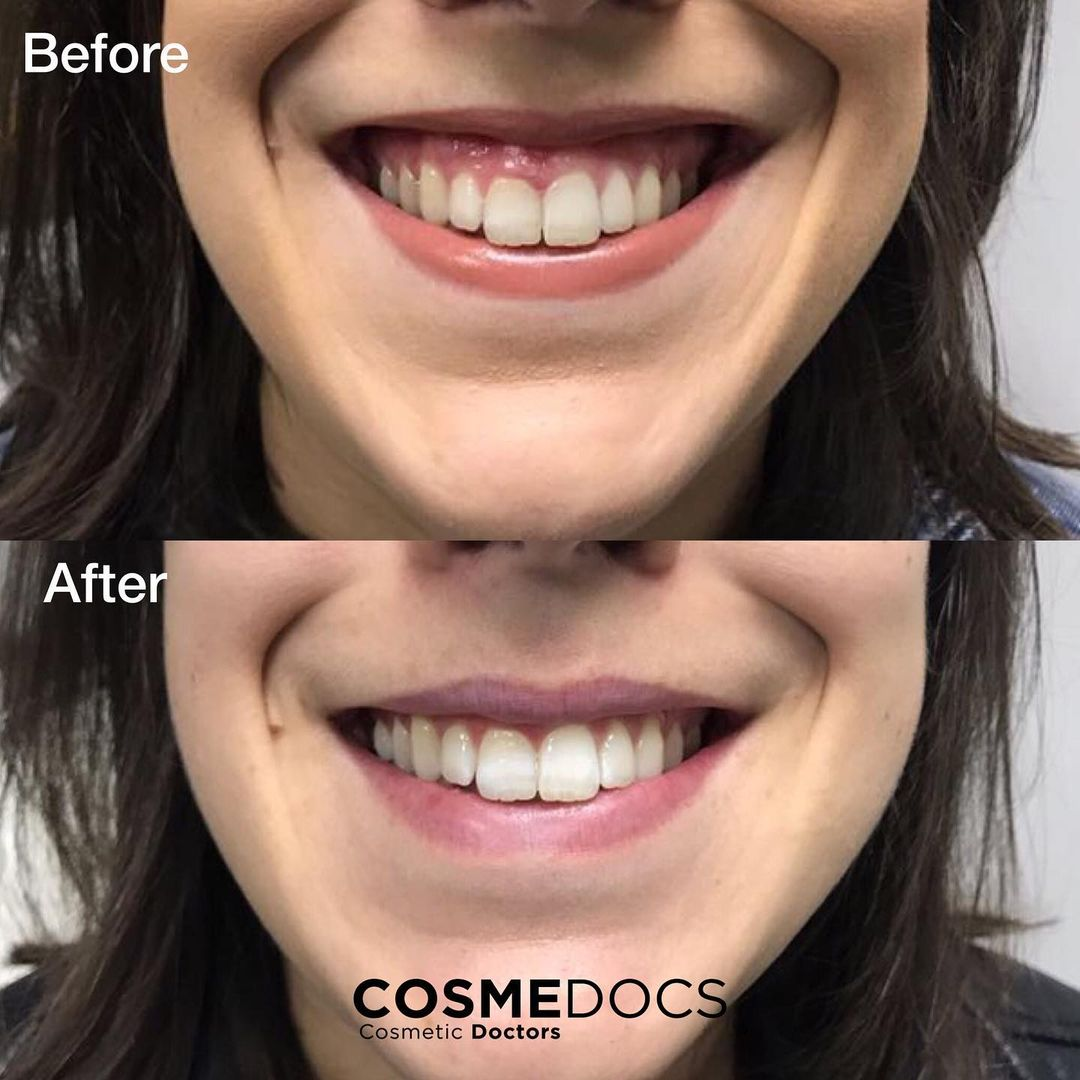 Before and after lip filler showing subtle enhancement with natural lip movement preserved during smiling