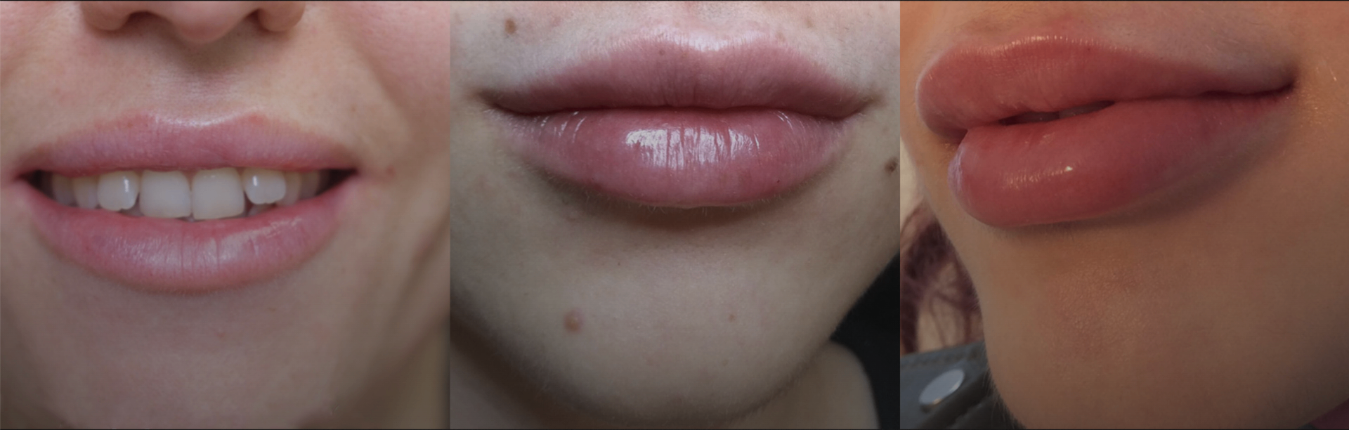 Three stages of lip filler showing natural lip, subtly enhanced lip with border definition, and full enhancement preserving natural shape